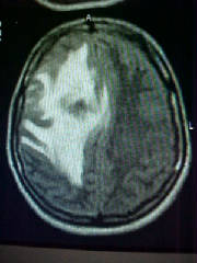 FLAIR Axial MR Brain